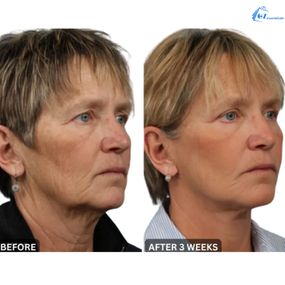 RejuvaGlow Anti-Wrinkle Massager